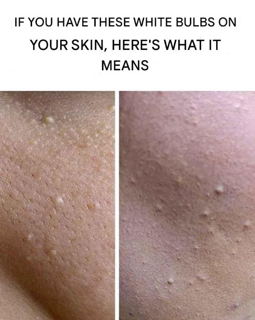 White Bumps on the Skin: What Do They Mean?