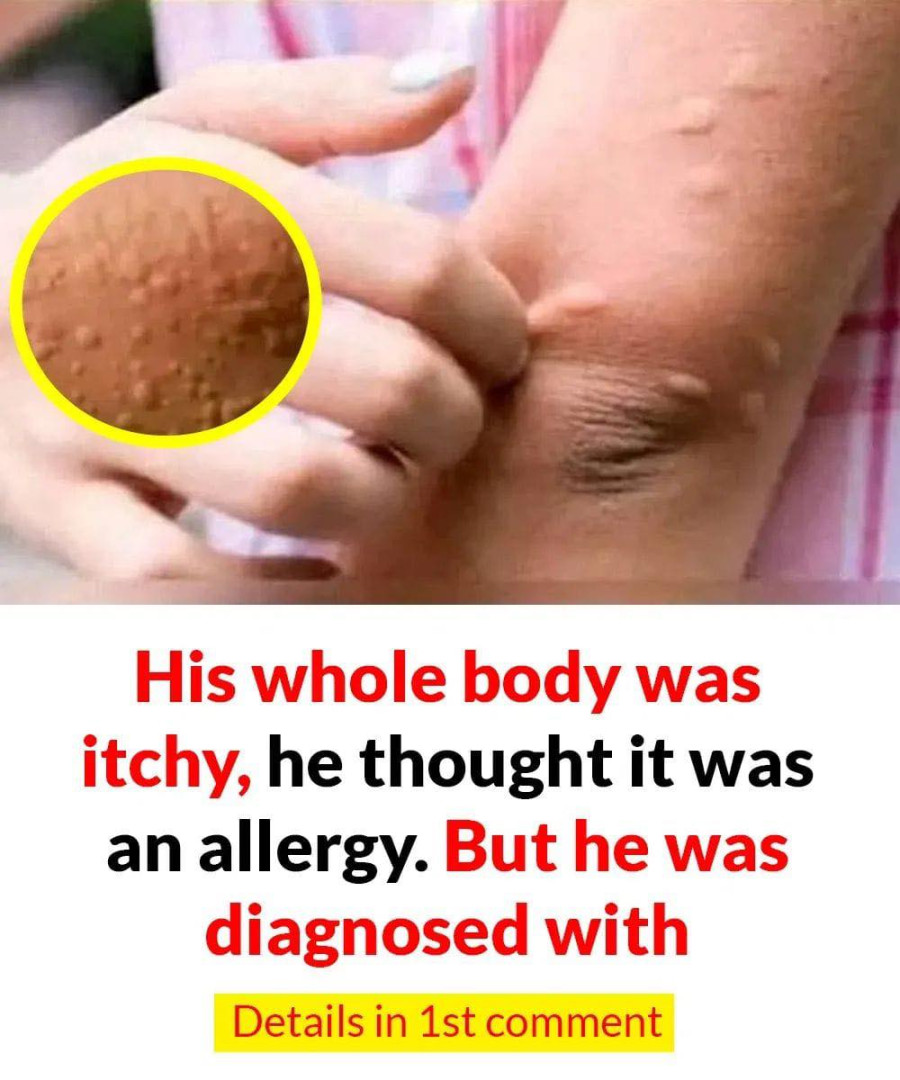 His whole body was itchy, he thought it was an allergy and was diagnosed
