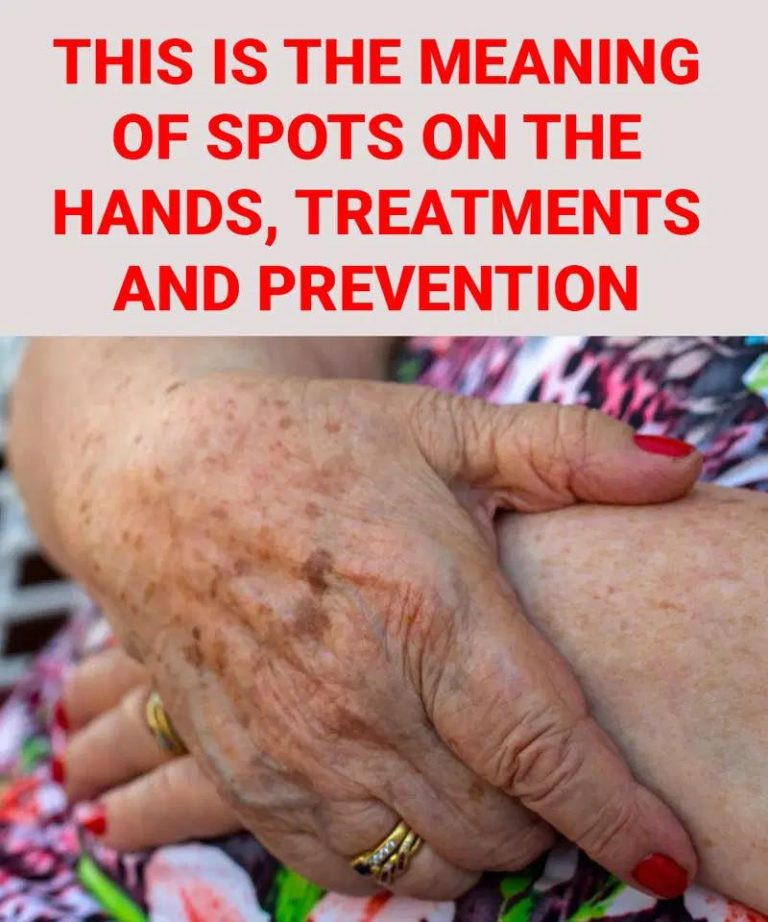 THIS IS THE MEANING OF SPOTS ON THE HANDS, TREATMENTS, AND PREVENTION