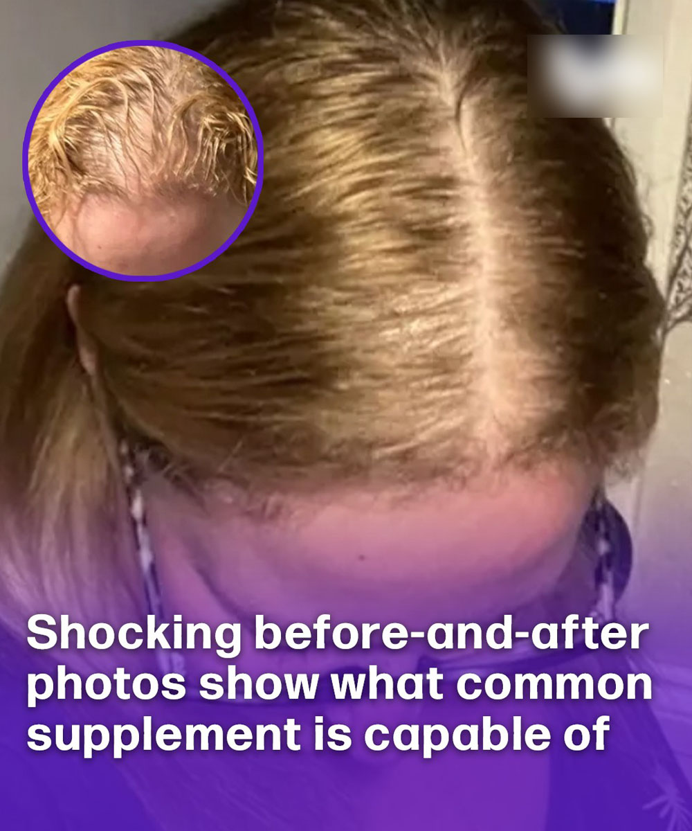Sh0cking before-and-after photos show what common supplement is capable of