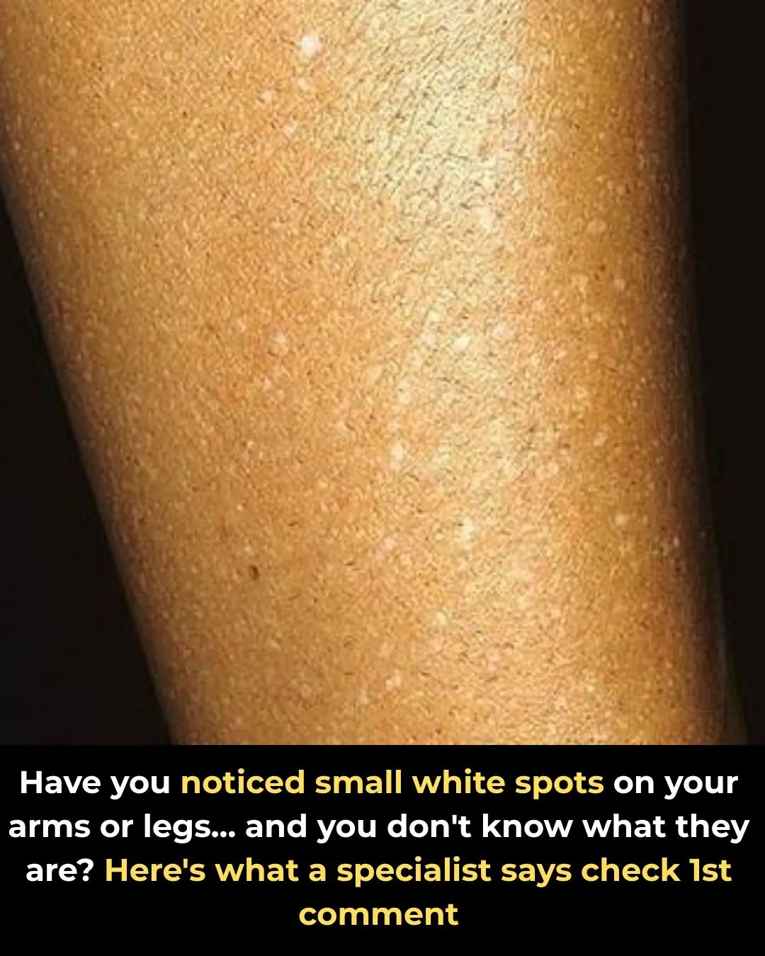 Have You Noticed Small White Spots on Your Arms or Legs and Don’t Know What They Are? Here’s What Experts Think