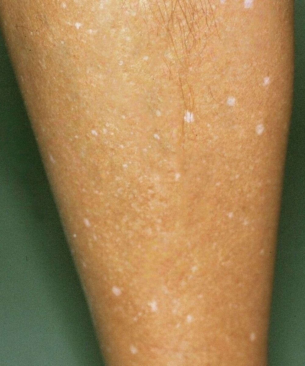 White Spots on Skin! Which Vitamin Deficiencies Could Be the Cause?