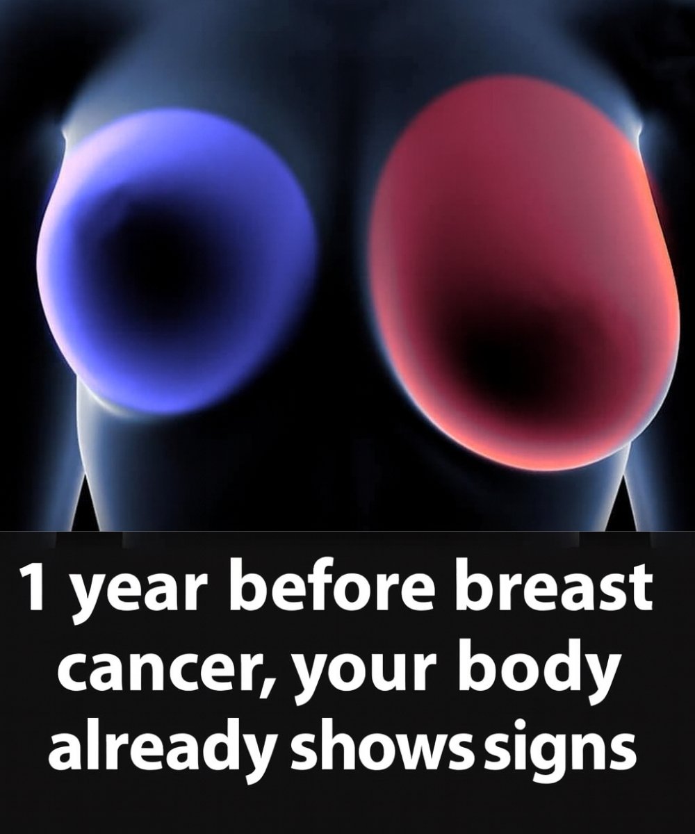 Breast Cancer: 4 Early Warning Signs Every Woman Should Know