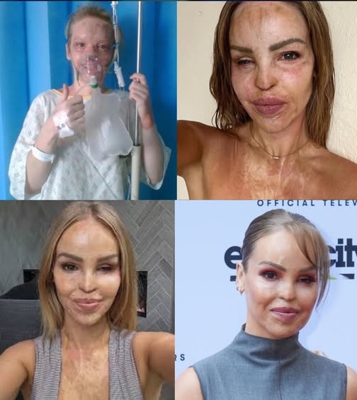 “FOR YEARS, I HID. TODAY, I SHOW THE WORLD MY SCARS AND MY STRENGTH — BECAUSE I AM MORE THAN WHAT THEY TRIED TO TAKE FROM ME.” Seventeen Years After A Horrific Acid Attack Left Katie Piper Blind In One Eye, Scarred Across Her Body, And Enduring Over 250 Surgeries, She Stepped Onto The Beach In A Bikini — And The World Stopped. Witnesses Were Frozen, One Whispering Through Tears: “She’s Not Just Surviving… She’s Reclaiming Every Piece Of Her Soul.” Social Media Erupted, Fans Calling It “The Bravest Moment Of The Decade,” While Katie Added Quietly: “I Won’t Hide Anymore. My Scars Tell My Story, My Strength Shows My Triumph.” Hundreds Of Thousands Watched, Heartbroken, Awed, And Inspired.
