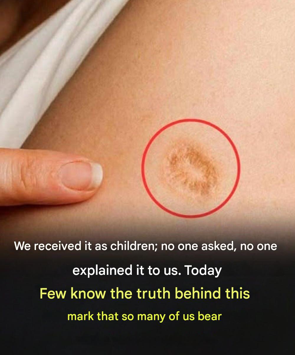 5 common misconceptions about the round scar on the upper arm