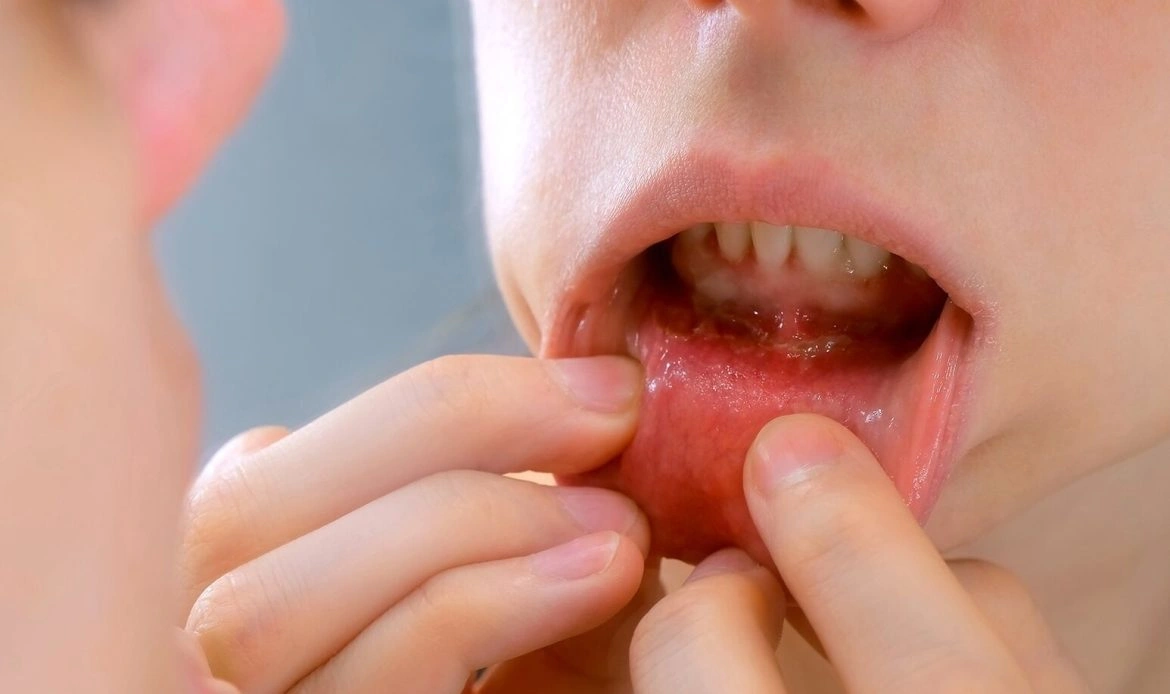 Oral Cancer: Early Warning Signs, Causes, and What Everyone Should Know